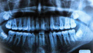 Root Canal Postoperative Instructions