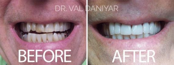 Smile Restoration Before and After Photos in Naples, FL