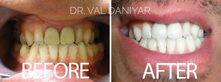 Teeth Whitening Before and After Photos in Naples, FL, Patient 2934