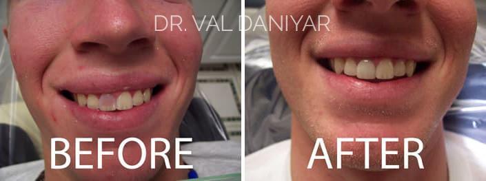 Veneers Before and After Photos in Naples, FL, Patient 2938