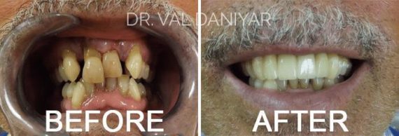Smile Makeover Before and After Photos in Naples, FL