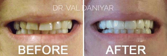 Crowns, Bridges and Implants Before and After Photos in Naples, FL, Patient 2946