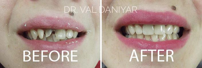 Crowns, Bridges and Implants Before and After Photos in Naples, FL, Patient 2962