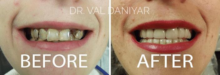 Crowns, Bridges and Implants Before and After Photos in Naples, FL, Patient 2966