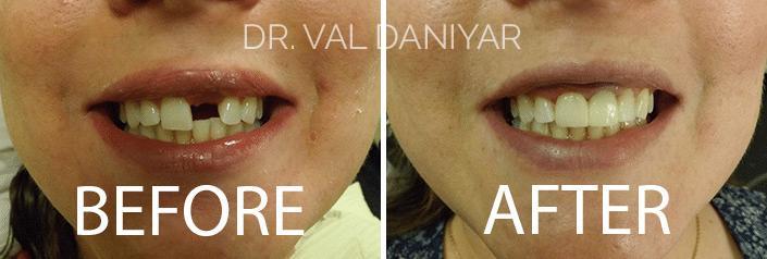 Crowns, Bridges and Implants Before and After Photos in Naples, FL, Patient 2970