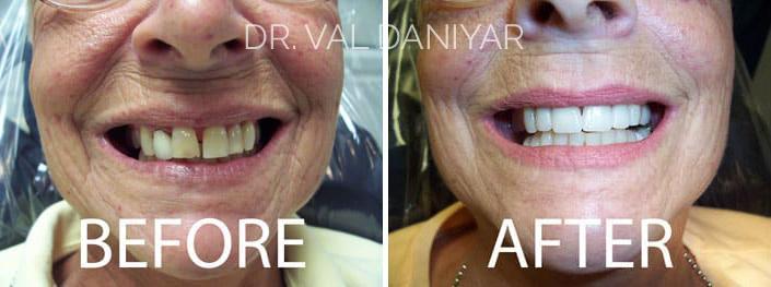 Crowns, Bridges and Implants Before and After Photos in Naples, FL, Patient 3006