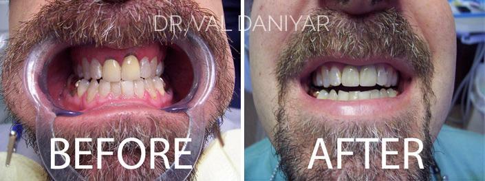 Crowns, Bridges and Implants Before and After Photos in Naples, FL, Patient 3010