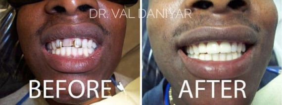 Before and After Photos in Naples, FL, Dental Bridges