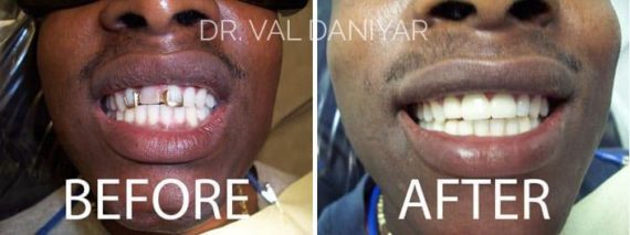  Before and After Photos in Naples, FL, Dental Bridges