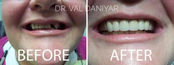  Before and After Photos in Naples, FL, Dental Bridges