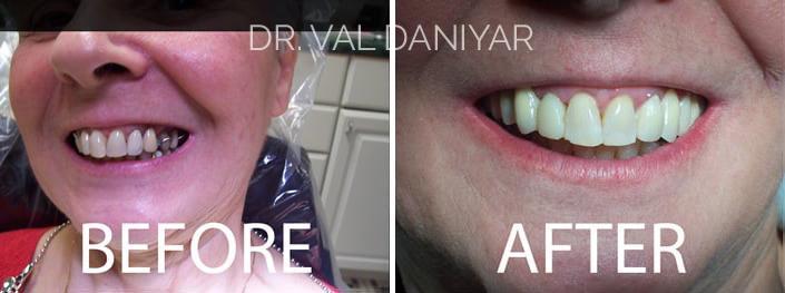 Smile Makeover Before and After Photos in Naples, FL, Patient 3026