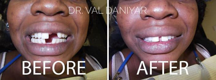 Crowns, Bridges and Implants Before and After Photos in Naples, FL, Patient 3042