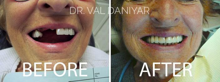 Crowns, Bridges and Implants Before and After Photos in Naples, FL, Patient 3046
