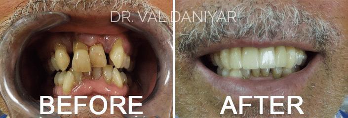  Before and After Photos in Naples, FL, Dental Crowns