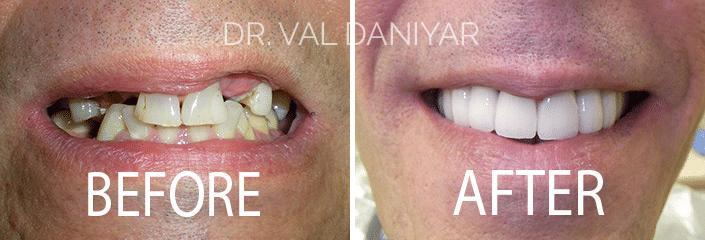 Smile Makeover Before and After Photos in Naples, FL, Patient 3346