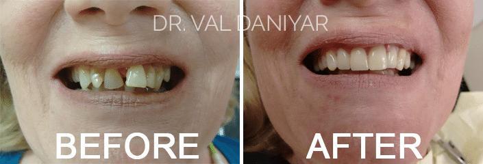 Smile Makeover Before and After Photos in Naples, FL, Patient 3305
