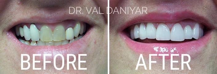 Smile Makeover Before and After Photos in Naples, FL, Patient 3310