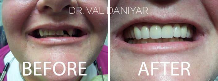 Smile Makeover Before and After Photos in Naples, FL, Patient 3320