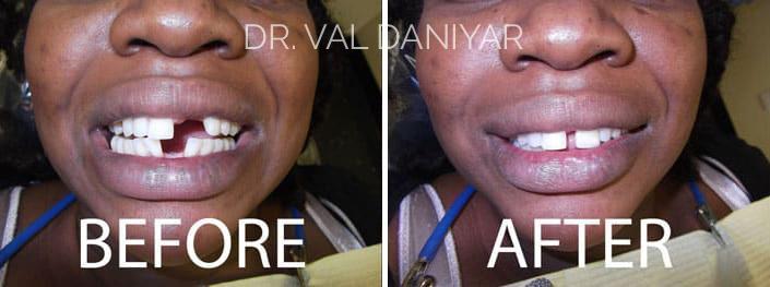 Smile Makeover Before and After Photos in Naples, FL, Patient 3330