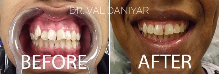 Smile Makeover Before and After Photos in Naples, FL, Patient 3339