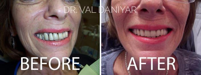 Smile Makeover Before and After Photos in Naples, FL, Patient 3341