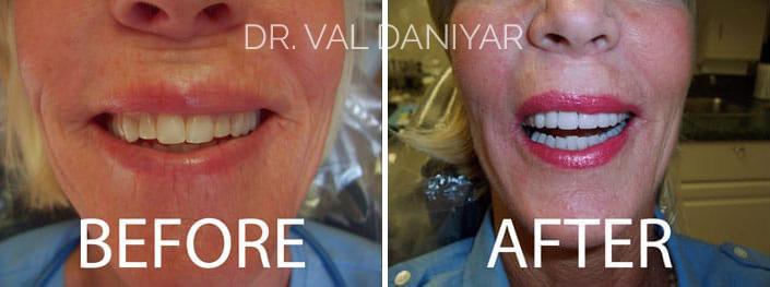 Smile Restoration Before and After Photos in Naples, FL, Patient 3324
