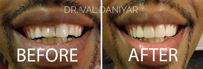 Smile Restoration Before and After Photos in Naples, FL, Patient 3377