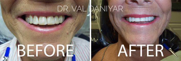 Smile Restoration Before and After Photos in Naples, FL, Patient 3335