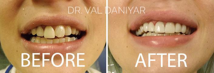 Smile Restoration Before and After Photos in Naples, FL, Patient 3361