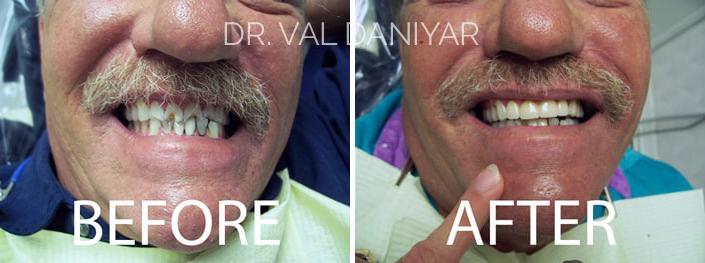 Smile Restoration Before and After Photos in Naples, FL, Patient 3369