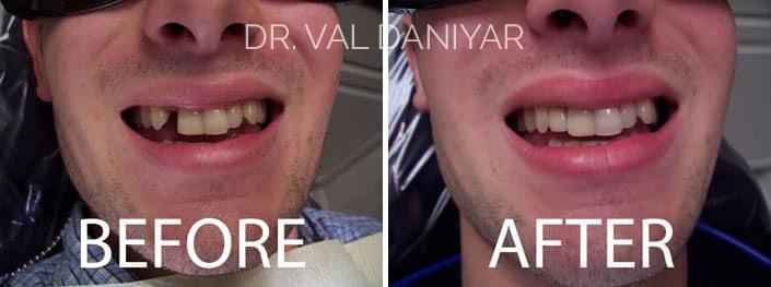 Smile Restoration Before and After Photos in Naples, FL, Patient 3373