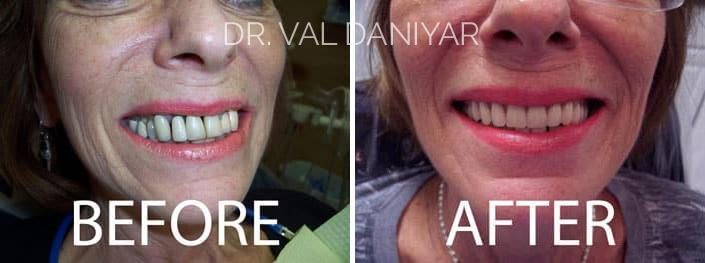  Before and After Photos in Naples, FL, Porcelain Veneers and Cosmetic Bonding