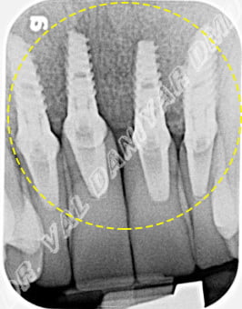 Same patient’s x-ray taken after successful treatment consisting on surgical bone regeneration and placement of extremely aligned implants with teeth.