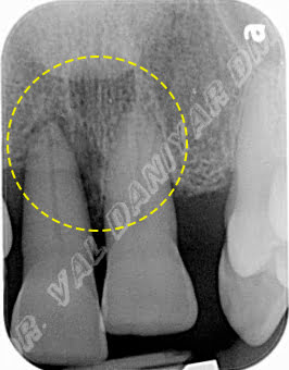 This x-ray shows advanced loss of the bone that normally supports teeth. The tooth roots seen here are barely held by remaining bone.