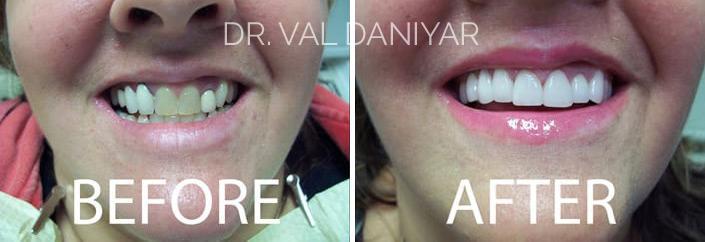  Before and After Photos in Naples, FL, Gum Disease Treatment