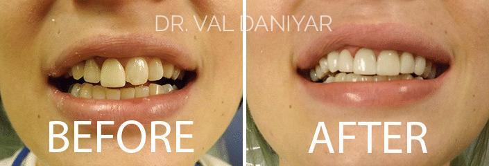  Before and After Photos in Naples, FL, Porcelain Veneers and Cosmetic Bonding