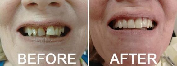  Before and After Photos in Naples, FL, Dental Bridges