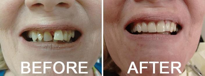  Before and After Photos in Naples, FL, Dental Crowns